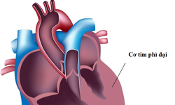 Cơ tim ph&#236; đại: Nguy&#234;n nh&#226;n, biểu hiện, c&#225;ch điều trị v&#224; ph&#242;ng bệnh