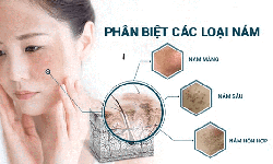 L&#224;m sao để kh&#244;ng bị t&#225;i n&#225;m da sau điều trị?