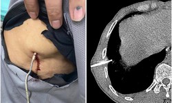 Kịp thời cứu sống bệnh nhân bị dây kẽm đâm xuyên ngực, bác sĩ chỉ cách sơ cứu đúng