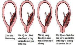 B&#225;c sĩ vượt 100km cứu sản phụ rau c&#224;i răng lược nguy kịch