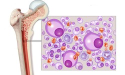 Đa u tủy xương: Nguy&#234;n nh&#226;n, biểu hiện, c&#225;ch điều trị v&#224; ph&#242;ng bệnh