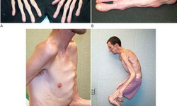 Hội chứng Marfan: Nguy&#234;n nh&#226;n, biểu hiện, c&#225;ch điều trị v&#224; ph&#242;ng bệnh