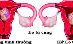 Hở eo tử cung: Nguy&#234;n nh&#226;n, biểu hiện, c&#225;ch điều trị v&#224; ph&#242;ng bệnh