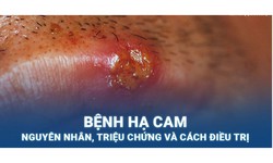 Hạ cam: Nguy&#234;n nh&#226;n, biểu hiện, c&#225;ch điều trị v&#224; ph&#242;ng bệnh