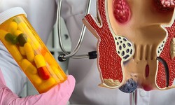 Hẹp hậu m&#244;n ở trẻ em: Nguy&#234;n nh&#226;n, biểu hiện, c&#225;ch điều trị v&#224; ph&#242;ng bệnh
