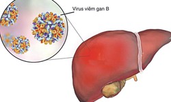 Vi&#234;m gan C: Nguy&#234;n nh&#226;n, triệu chứng, ph&#242;ng ngừa v&#224; điều trị