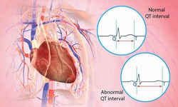 Hội chứng QT k&#233;o d&#224;i: Nguy&#234;n nh&#226;n, biểu hiện, c&#225;ch điều trị v&#224; ph&#242;ng bệnh