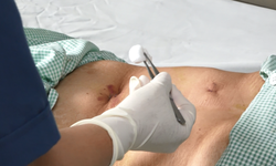 C&#226;u hỏi thường gặp về hội chứng quai m&#249;