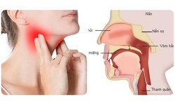 C&#225;c yếu tố nguy cơ g&#226;y ung thư v&#242;m họng ở phụ nữ 