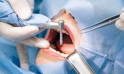 Cấy ghép Implant có đau không? Những điều cần biết về cảm giác đau