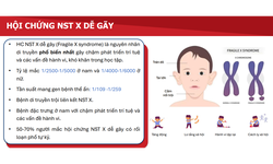Hội chứng Fragile X – Nguy&#234;n nh&#226;n di truyền phổ biến g&#226;y thiểu năng tr&#237; tuệ ở trẻ