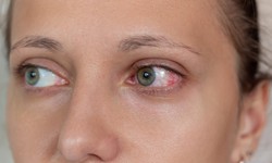 7 c&#226;u hỏi thường gặp về hội chứng Behcet