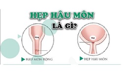 C&#226;u hỏi thường gặp li&#234;n quan đến hẹp hậu m&#244;n ở trẻ em
