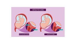 C&#226;u hỏi thường gặp li&#234;n quan đến bệnh hở eo tử cung