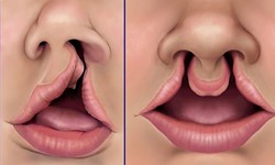 C&#226;u hỏi thường gặp li&#234;n quan đến hở h&#224;m ếch