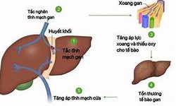 C&#225;c thuốc điều trị Hội chứng Budd-Chiari