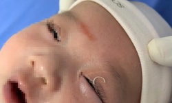 Hy hữu: Mẹ cắt m&#243;ng tay khiến dị vật rơi v&#224;o mắt con 2 th&#225;ng tuổi