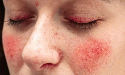 Câu hỏi thường gặp về hội chứng Carcinoid