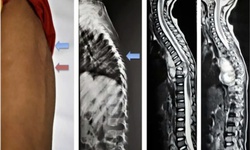 Câu hỏi thường gặp về lao cột sống