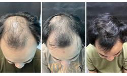 Xu hướng điều trị rụng t&#243;c mới năm 2025