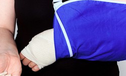 C&#226;u hỏi thường gặp li&#234;n quan đến hội chứng Sudeck