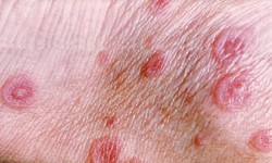 C&#226;u hỏi thường gặp li&#234;n quan đến bệnh hồng ban đa dạng