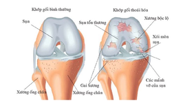 Người bệnh tho&#225;i h&#243;a khớp gối tập luyện thế n&#224;o cho ph&#249; hợp?