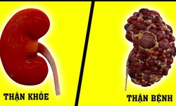 4 th&#243;i quen g&#226;y hỏng thận nhanh nhất cần thay đổi ngay