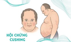 Người mắc hội chứng Cushing tập luyện thế n&#224;o c&#243; lợi cho sức khỏe?