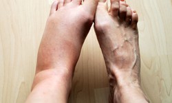 C&#225;c thuốc g&#226;y ph&#249; ch&#226;n, xử tr&#237; như thế n&#224;o?