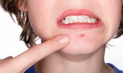 Điều trị mụn như thế n&#224;o l&#224; đ&#250;ng c&#225;ch v&#224; bao l&#226;u sẽ c&#243; hiệu quả?