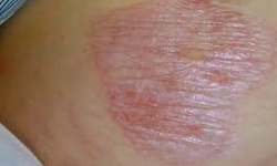 C&#226;u hỏi thường gặp li&#234;n quan đến bệnh lichen xơ h&#243;a
