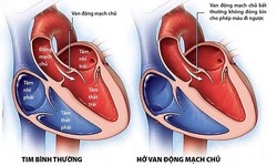 C&#226;u hỏi thường gặp li&#234;n quan đến bệnh l&#243;c t&#225;ch động mạch chủ