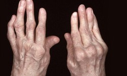 C&#225;c thuốc trị vi&#234;m khớp dạng thấp