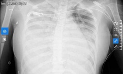 Chỉ với triệu chứng như cảm c&#250;m, nữ sinh được ph&#225;t hiện nhiễm li&#234;n cầu khuẩn nh&#243;m A nguy kịch