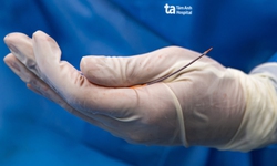 Stent phủ thuốc thế hệ mới giúp kéo dài tuổi thọ cho bệnh nhân tim mạch