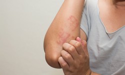 C&#226;u hỏi thường gặp li&#234;n quan đến hội chứng Lyell