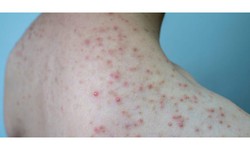 Những lưu &#253; khi tập thể dục ở người bị vi&#234;m nang l&#244;ng