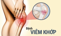 Vi&#234;m khớp: Nguy&#234;n nh&#226;n, triệu chứng, c&#225;ch điều trị v&#224; ph&#242;ng ngừa