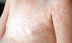 Xử l&#253; triệt để c&#225;c ổ dịch sốt xuất huyết ngay từ khi xuất hiện