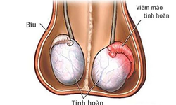 Những c&#226;u hỏi thường gặp về bệnh vi&#234;m m&#224;o tinh ho&#224;n