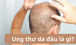 Ung thư da đầu: Nguy&#234;n nh&#226;n, triệu chứng, c&#225;ch điều trị v&#224; ph&#242;ng bệnh