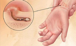 C&#226;u hỏi thường gặp li&#234;n quan đến bệnh ghẻ