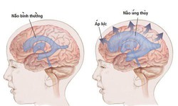 C&#226;u hỏi thường gặp li&#234;n quan đến bệnh gi&#227;n n&#227;o thất