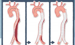 L&#243;c t&#225;ch động mạch chủ: Nguy&#234;n nh&#226;n, biểu hiện, c&#225;ch điều trị v&#224; ph&#242;ng bệnh