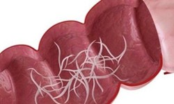 C&#226;u hỏi thường gặp li&#234;n quan đến bệnh giun kim