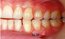 Tụt lợi điều trị được kh&#244;ng v&#224; c&#225;ch khắc phục