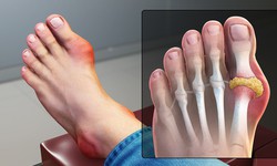Người c&#243; nguy cơ cao mắc bệnh gout cần lưu &#253; g&#236;?