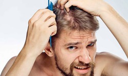 Rụng t&#243;c ở nam giới v&#224; giải ph&#225;p khắc phục