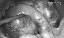 Bệnh viện tuyến quận cấp cứu th&#224;nh c&#244;ng hai ca xoắn cơ quan sinh dục nguy hiểm
